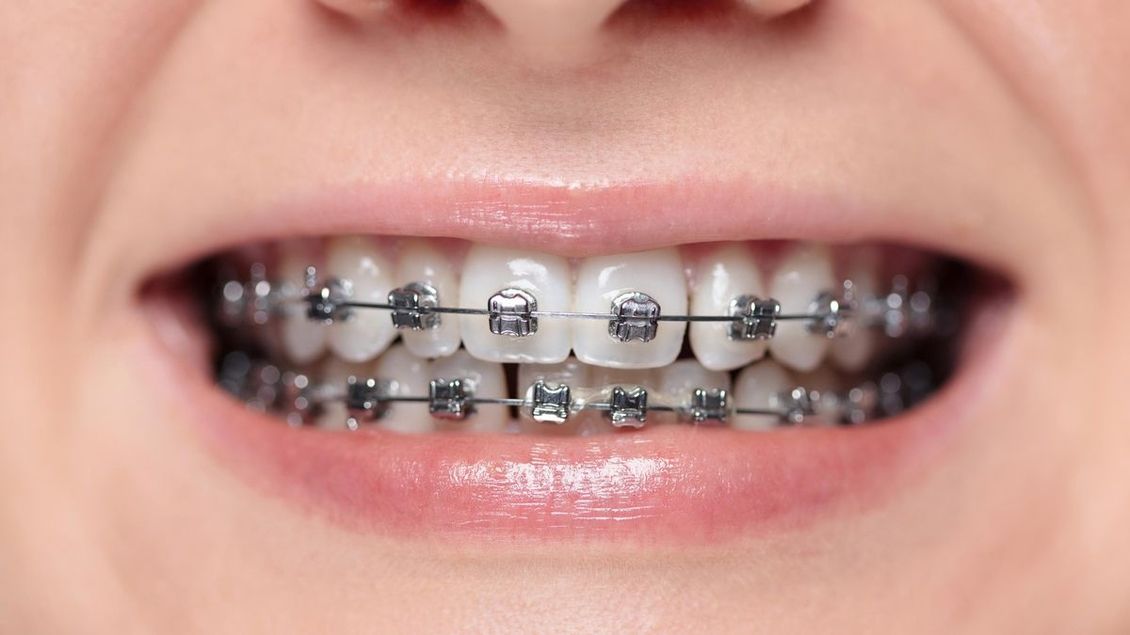 Glosa: Rovnátka za 70 tisíc. A jiné důvody, proč Češi odkládají rodičovství - Seznam Zprávy