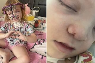 Konec trápení pro malou Lilli. Šrouby jsou konečně venku, obličej k nepoznání