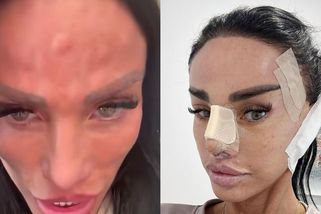 Botoxové Katie Price se na čele objevily nevzhledné boule