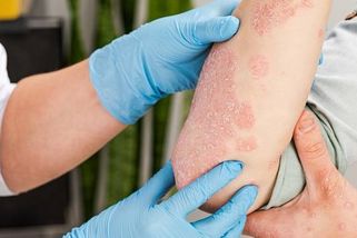 V Evropě se objevila nebezpečná plíseň. Léčba vyžaduje měsíce hospitalizace