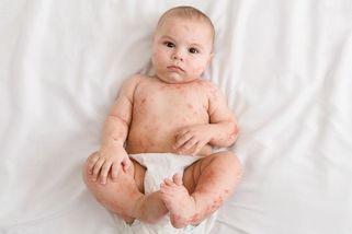 Mezi děti se vracejí plané neštovice, násobně vzrostl počet virových střevních infekcí - Novinky