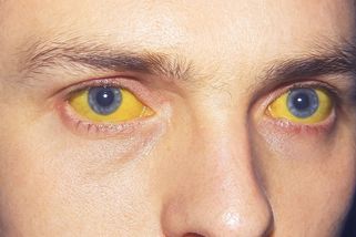 Za největší epidemii žloutenky u nás mohly jahodové nanuky. Nemocnice byly přeplněné a režim mlčel - Médium.cz