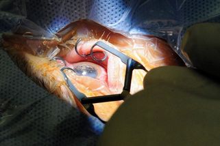 Šedý zákal: Nečekejte, až „dozraje“ - Novinky