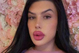 Modelka s největšími rty v Británii si nechala rozpustit výplně a ukázala rozdíl. Změna jí prospěla, ona se ale stydí - Super.cz