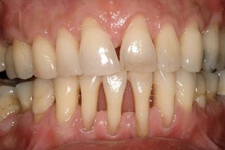 Parodontóza není jen o zubech. Zánět v ústech je přímou cestou k infarktu, varují experti