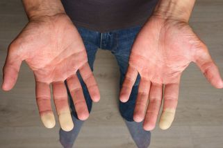 Trápí vás věčně studené ruce? Vědci už zjistili, co za tím stojí - Novinky