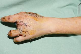 Čeští lékaři vyzývají: Podívejte se, jak mrzačí petardy, ohňostroj si odpustíte - Seznam Zprávy