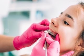 Za rovnátka platí pacienti desetitisíce. Odborníci vysvětlují proč - Seznam Zprávy