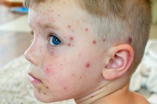 Hygienička: Covid neštovice utlumil, letos může být rekordní počet nakažených - Seznam Zprávy