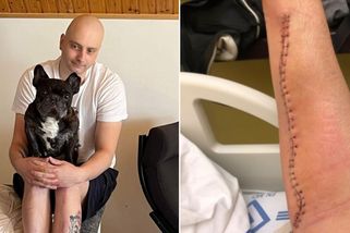 Lékař podcenil bouli na ruce, jde o vzácnou formu rakoviny. Za léčbou musí Roman do Ameriky - Novinky