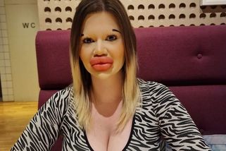 Žena s „největšími rty na světě“ si nechala vpravit šest výplní najednou. Chtěla vidět, co její tělo vydrží - Super.cz