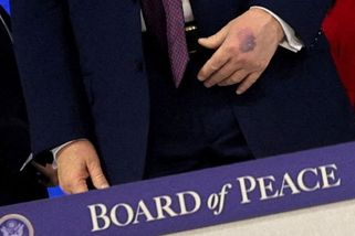 Trump má na ruce obrovskou modřinu. Přišel k ní při podpisu Rady míru - Novinky