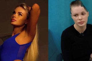 Modelka po brutálním útoku přítele skončila bez části lebky