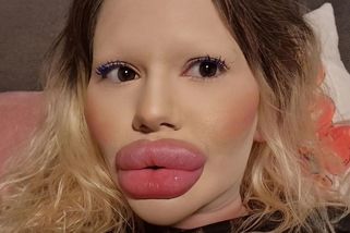 U 30 doktorů je na černé listině: Odmítají se mě dotknout, stěžuje si žena s údajně největšími rty na světě - Super.cz