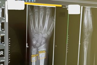 Žádné USB. Rentgenový snímek dostávají pacienti stále na DVD, brzy si ho nikde nepřehrají - Novinky