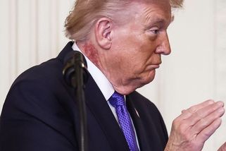 Trump upoutal další skvrnou, tentokrát na krku - Novinky
