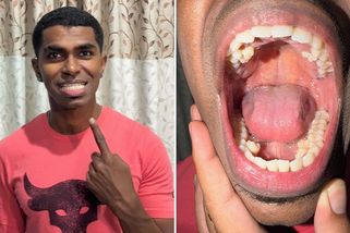 Muž z Malajsie má rekordních 42 zubů. Přišel na to při rodinném setkání u čaje - Novinky