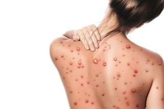 Vše, co potřebujete vědět o opičích neštovicích (mpox): Příznaky, na co si dát pozor a jak se léčí - Proženy.cz