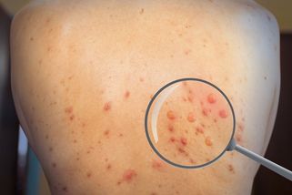 Evropa hlásí první případ nakažlivější varianty onemocnění mpox - Seznam Zprávy