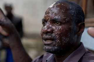 Onemocnění mpox se objevilo ve Švédsku. Jedná se o první případ závažnější varianty viru mimo Afriku