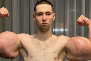 Lidé nevěřili, že přežije. Podívejte se, jak vypadají jeho ruce po červnové operaci