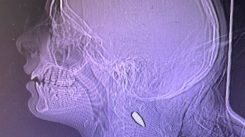 Snímky kulek v hlavách palestinských dětí vyvolávají pochybnosti - Novinky