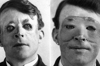 Harold Gillies: chirurg, jenž dal znetvořeným mužům druhou šanci - Médium.cz