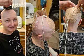 S elektrodami na hlavě proti rakovině? Jaroslava z Teplicka líčí drsnou realitu