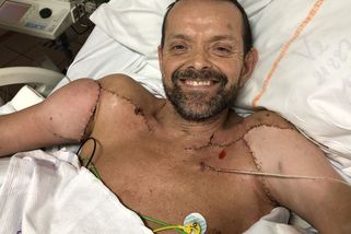 Elektrický proud mu spálil obě ruce. Stal se prvním člověkem s transplantací celých paží na světě - Médium.cz