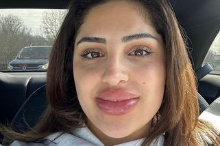 Žena šetřila na redukci výplní: Rty jí nabobtnaly do abnormálních rozměrů!