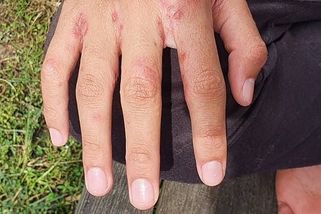 Svrabu je v Česku víc a víc. Podívejte se, jak ho poznat a jak se léčit