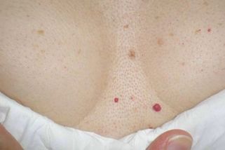 Červené tečky na kůži: O jaká onemocnění se může jednat