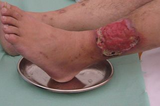 Jak zhojit bércový vřed, radí fyzioterapeutka. Varuje před běžně rozšířenými nesmysly - Česko Živě