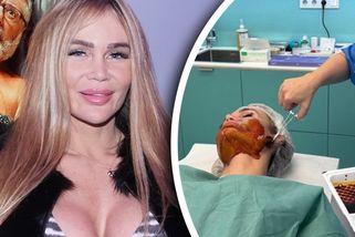 Nová láska, nový obličej! Bývalka Jaromíra Soukupa si nechala do tváře aplikovat dva metry nití!