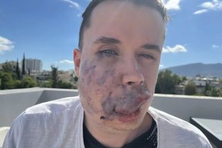 Cévní onemocnění deformuje Lukášovi obličej. Začalo to červeným znaménkem