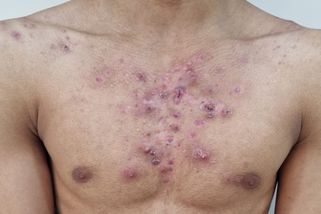 19letý kulturista se může pochlubit neskutečnou formou. Steroidy odmítá, jeho akné však děsí