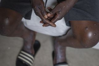 Afrika nemá v boji proti mpox dost peněz - Novinky