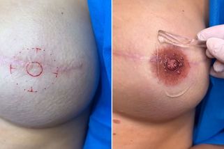 Vytetovat ženám po rakovině prsu bradavky dělá rodačce z Karviné největší radost - Novinky