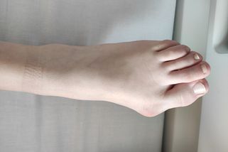 Vbočený palec: Krásné boty zanechají trvalé stopy