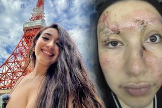 Jela rychle, bez pásů a bourala: Krásná influencerka končila se zdevastovaným obličejem