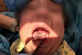 Na Ostravsku se potvrdil záškrt u dvou dětí a jedné ženy