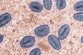 WHO vyhlásila nejvyšší stupeň varování kvůli opičím neštovicím - Novinky