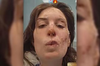 Nepředstavitelná bolest a každodenní boj. Eleanor přežila požár ve švýcarském baru - Novinky