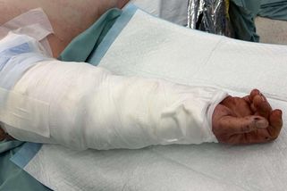 Pásový dopravník utrhl muži ruku. Lékaři v Brně mu jí přišili zpátky - Novinky