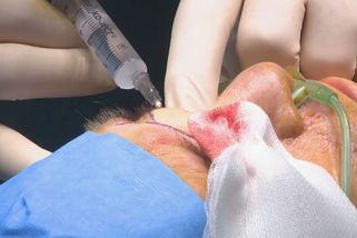 Lékaři v Brně provedli kompletní rekonstrukci nosu po rakovině