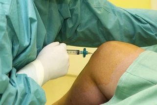 Průlom v léčbě osteoartrózy: Namísto operace bude stačit jediná injekce