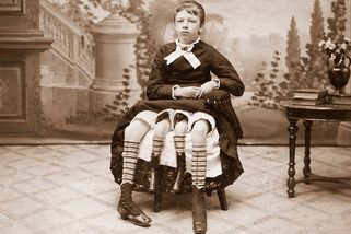 Čtyři nohy a dva funkční pohlavní orgány: Neuvěřitelný život a smutný konec Myrtle Corbin - Médium.cz
