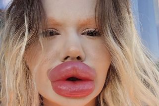 Žena s největšími rty opět v rukách lékařů: Svým vzhledem děsí fanoušky, fatálních následků se nebojí - Super.cz