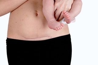 Počet císařských řezů roste. Rozhodující je přitom věk při prvním porodu, říká přední porodník - Proženy.cz