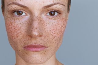 Dívky si sprejem na šediny stříkají umělé pihy. Nový beauty trend z TikToku děsí odborníky